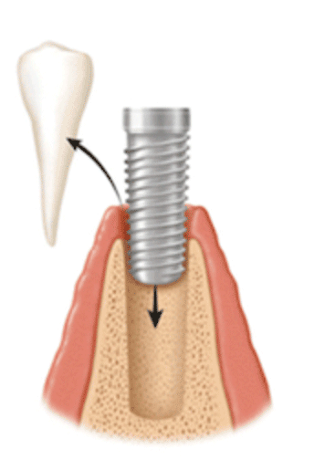 paso0 Implante dental