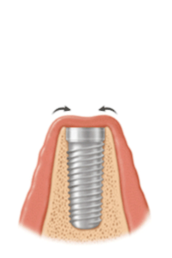 paso1 Implante dental