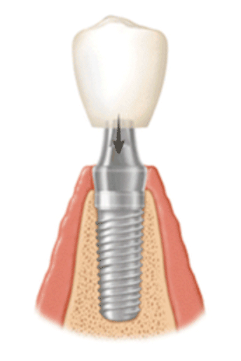 paso2 Implante dental