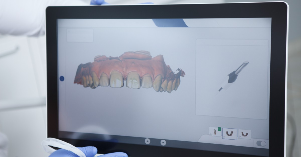 Escáner intraoral Madrid