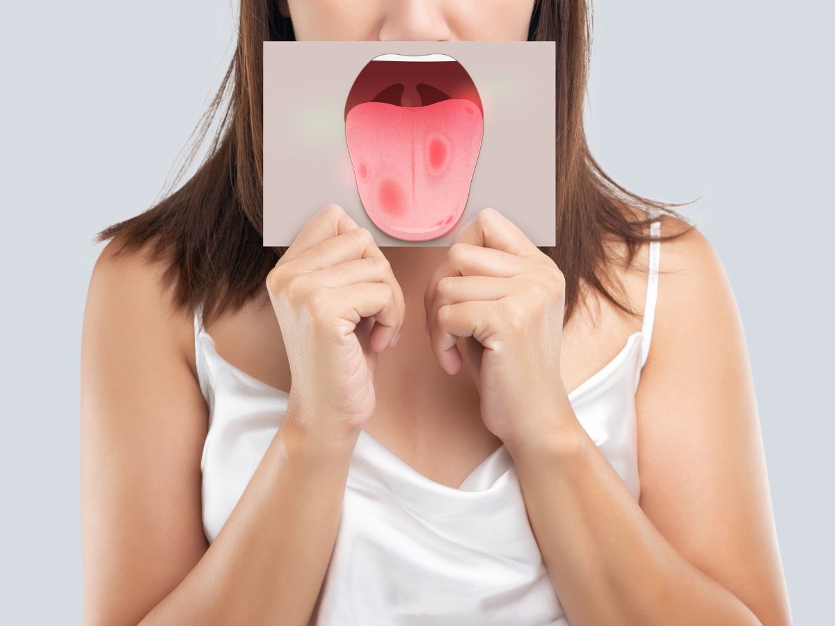 Que es la papilitis lingual