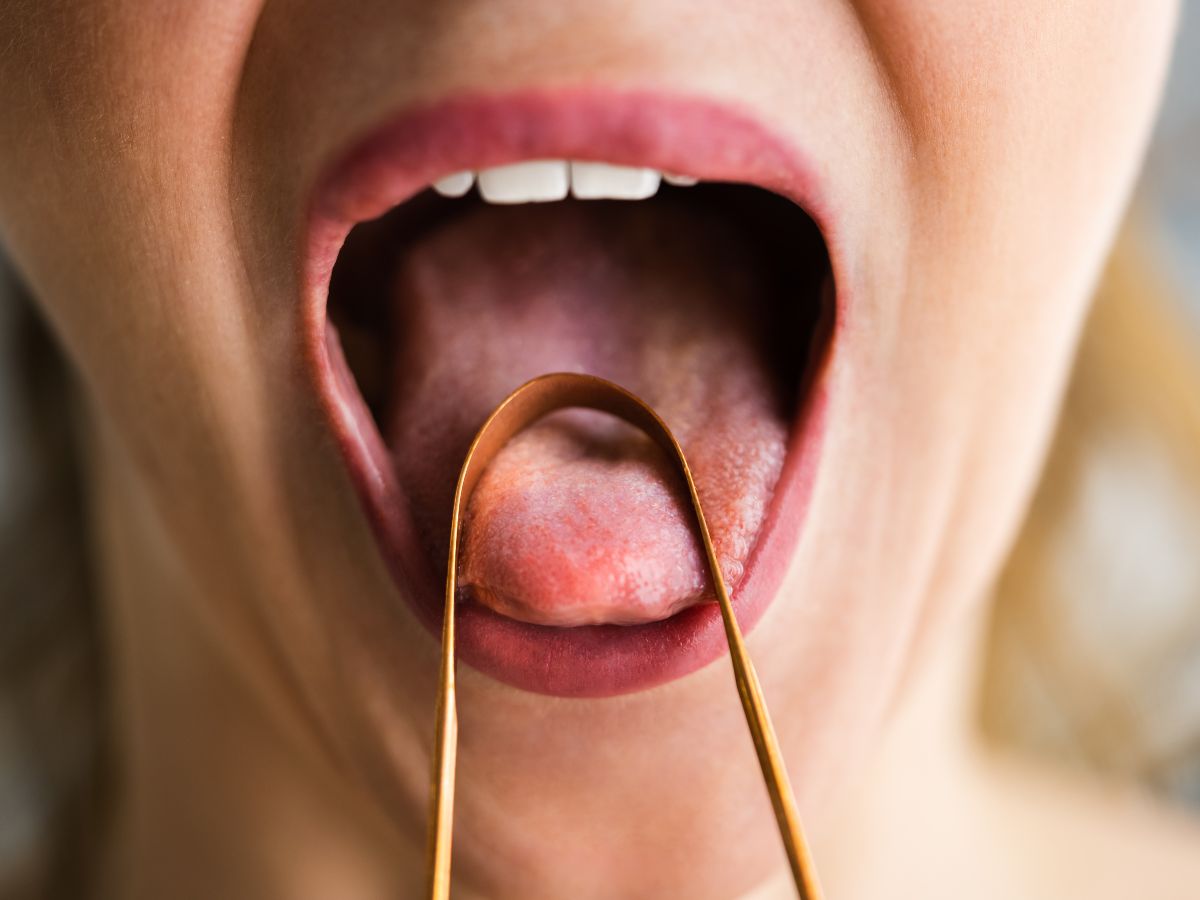 Papilitis lingual como se cura